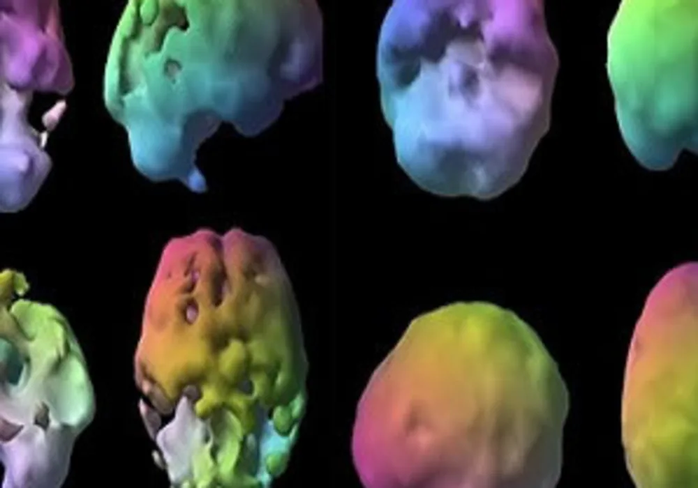 Representative brain SPECT scans in a patient with Alzheimer&#039;s dementia showing substantially reduced brain blood flow in the temporal and parietal lobes compared to a person with depression with mild decreased frontal lobe blood flow.