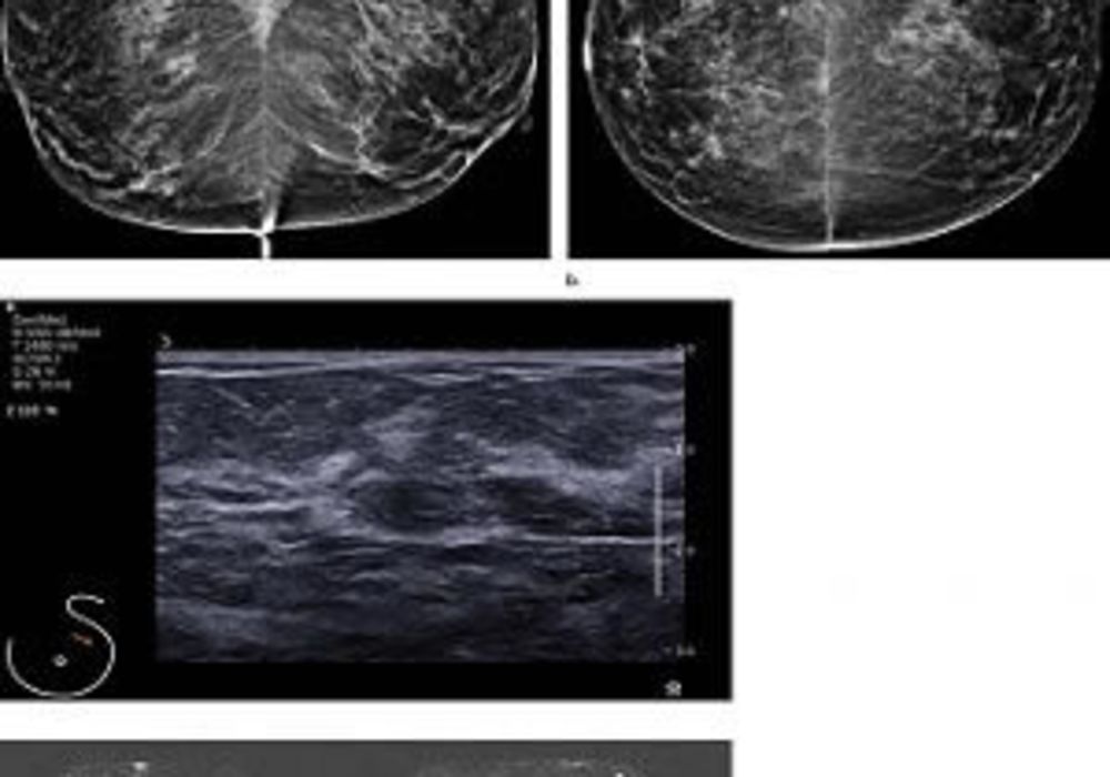 Images in a 55-year-old screening participant. (a, b) Normal digital full-field mediolateral oblique (a) and craniocaudal (b) mammograms (BI-RADS category 1) show a heterogeneously dense breast (ACR category C). (c) Screening ultrasound image shows normal