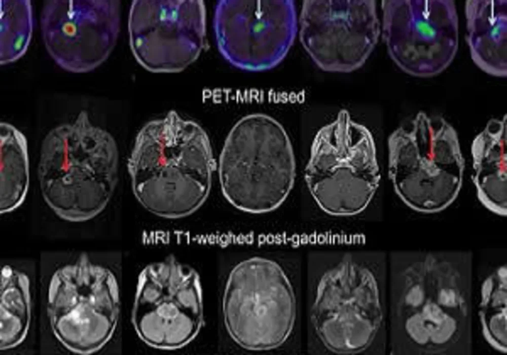 PET/CT Predicts Therapy Effectiveness in Paediatric Brain Tumours