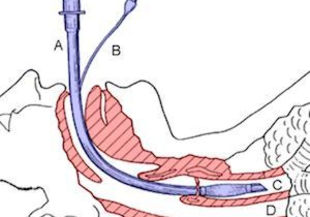 Ventilation: Weaning/Post-extubation Management