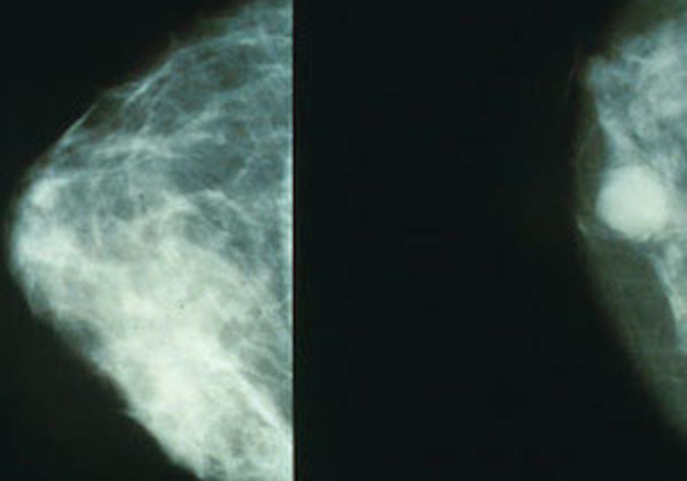 Screen-detected Breast Cancers Don&#039;t Regress If Left Untreated