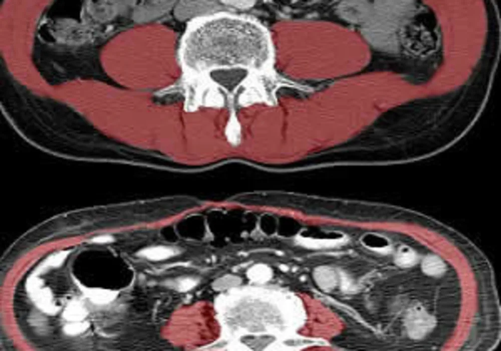 A new study of CTs shows that reduced size and density of core muscle (highlighted in red) as shown in the lower image is associated with frailty and reduced lifespan in hip-fracture patients.