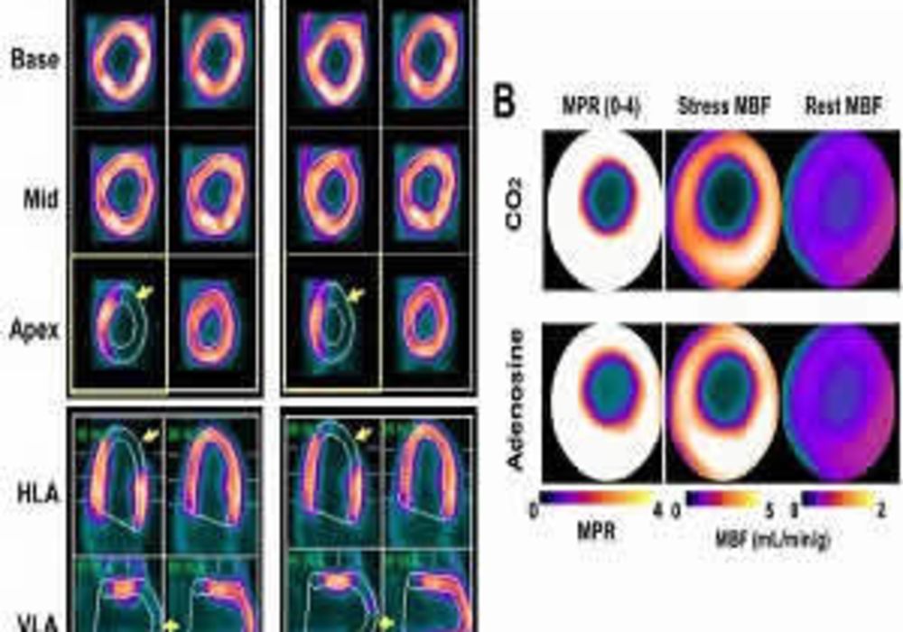 Panel A shows representative short and long-axis PET images of peak myocardial uptake of 13N-ammonia during hypercapnia of PaCO2 ~ 60 mmHg (CO2), standard clinical dose of adenosine (Adenosine) and at rest with PaCO2 ~ 35 mmHg (Rest) in a canine with a LA