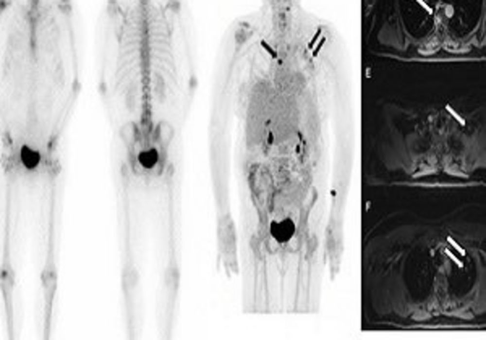 Tc-99m MDP bone scan (left) is negative for osseous lesions. NaF/FDG PET/MRI (right and second slide) confirms absence of bone metastases, but shows liver metastases.