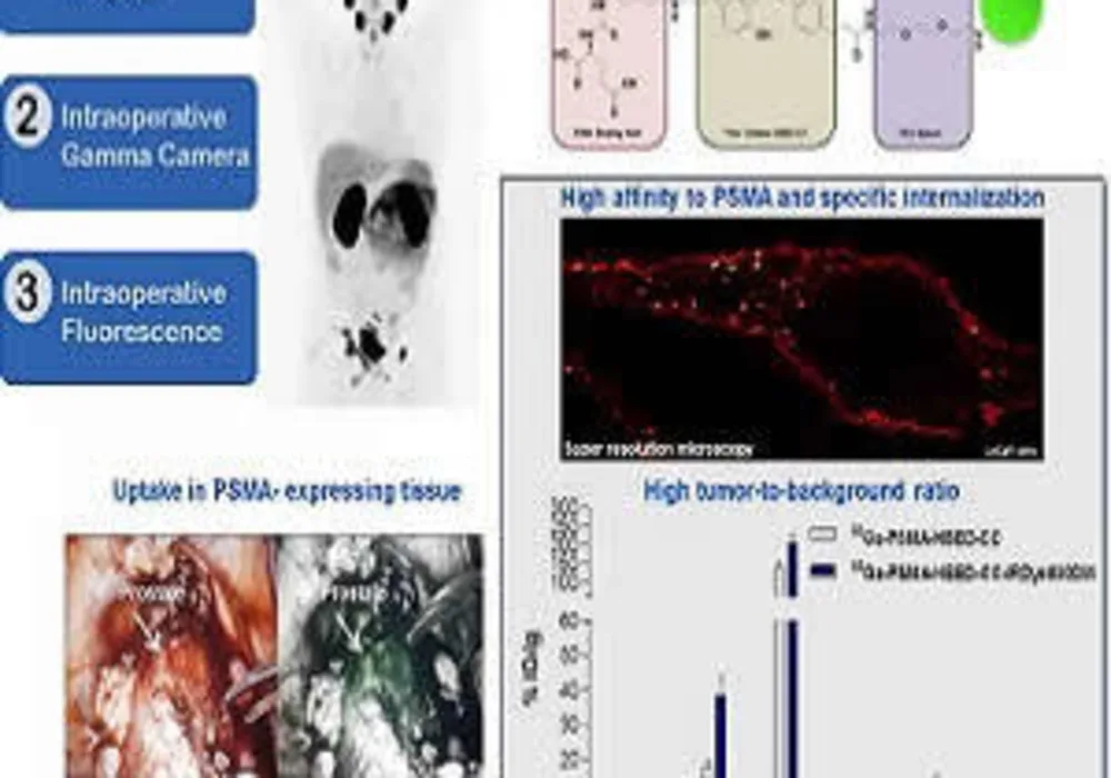 Technology of dual-labeled PSMA-inhibitors for PET/CT imaging and fluorescence-guided intraoperative identification of metastases. This work might help to establish a new treatment regimen for more precise and sensitive pre-, intra- and post-therapeutic d