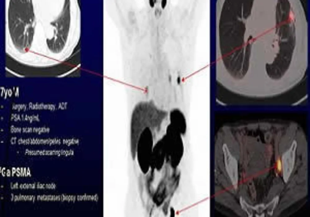 A 77-year-old male with recurrent lymph node and pulmonary metastases detected by Ga-68 PSMA PET/CT but not by conventional imaging.