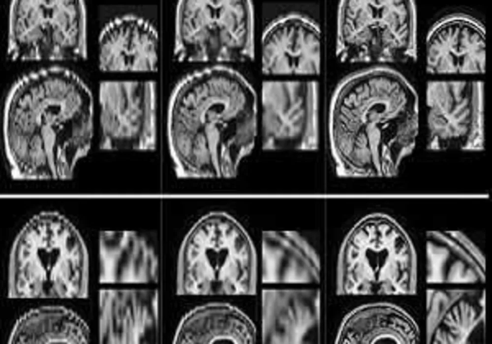 Researchers at MIT and other institutions have devised a way to boost the quality of low-resolution patient MRI scans so they can be used for large-scale studies. Images produced by their algorithm, shown in the center column, are much closer to high-reso