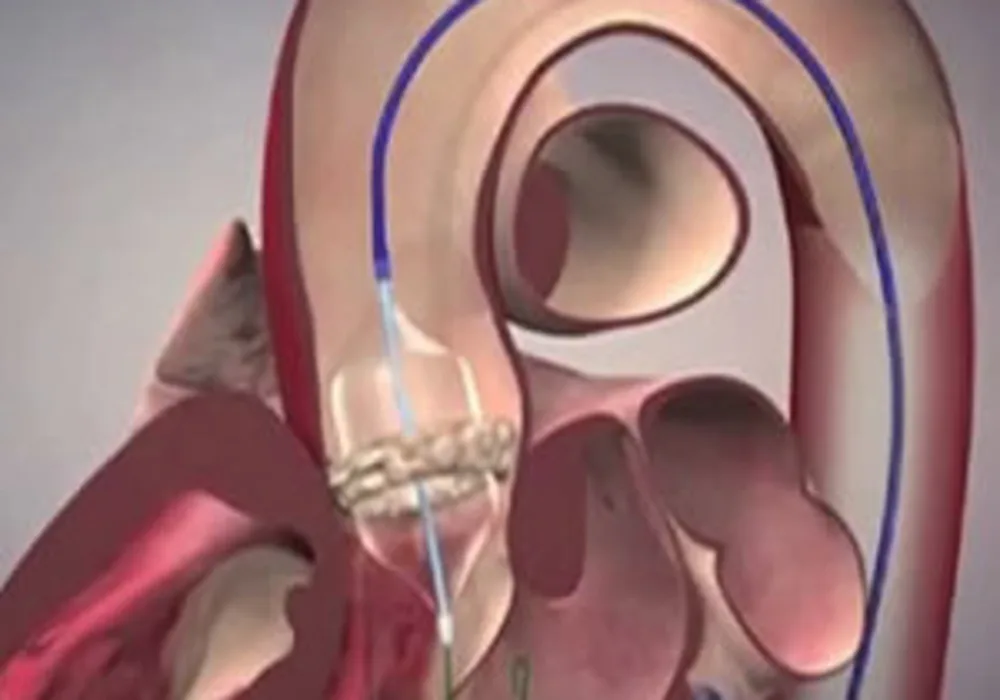 TAVR Improving with Advanced Technologies