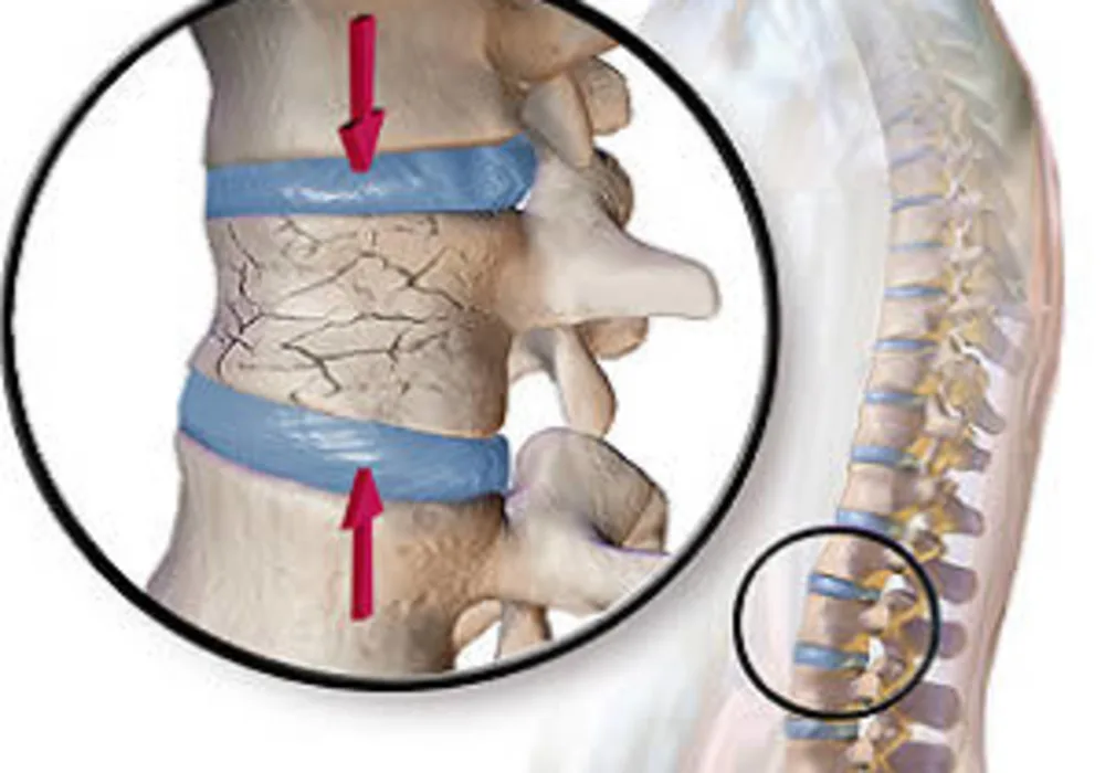 Radiology of Vertebral Fractures in Women and Men