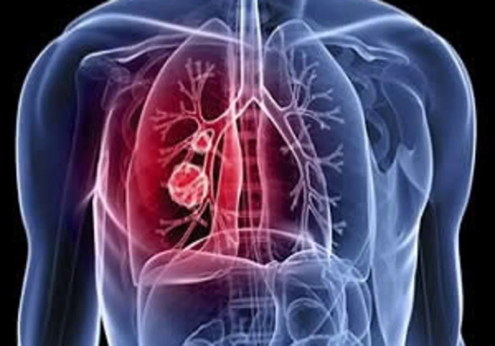 Lung cancer: differentiating metastatic from nonmetastatic lymph nodes 