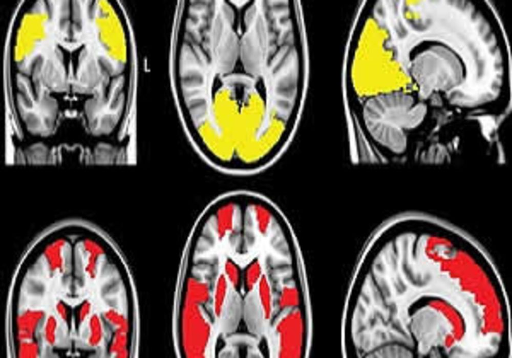 MR images show reduced regional functional connectivity in, A, Parkinson&rsquo;s disease (PD) patients and, B, exclusively in PD + visual hallucinations (VH) patients. Regional functional connectivity analysis revealed lower functional connectivity in PD + VH a