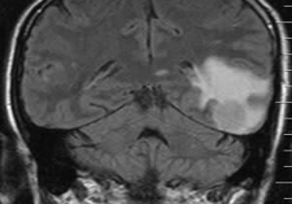 Quantitative FLAIR MRI in amyotrophic lateral sclerosis 