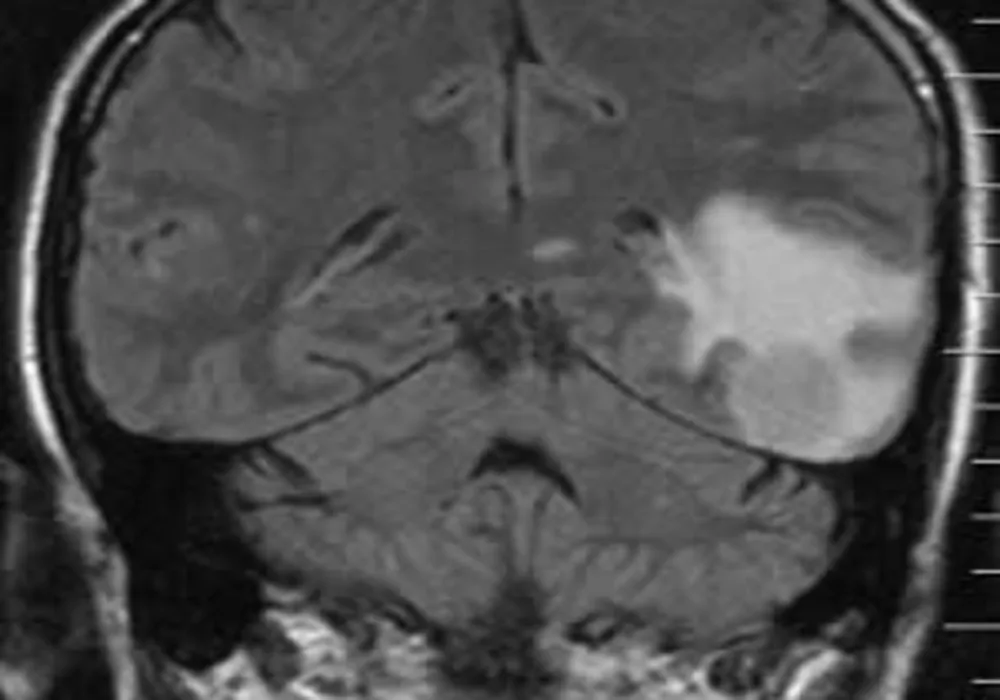 Quantitative FLAIR MRI in amyotrophic lateral sclerosis 