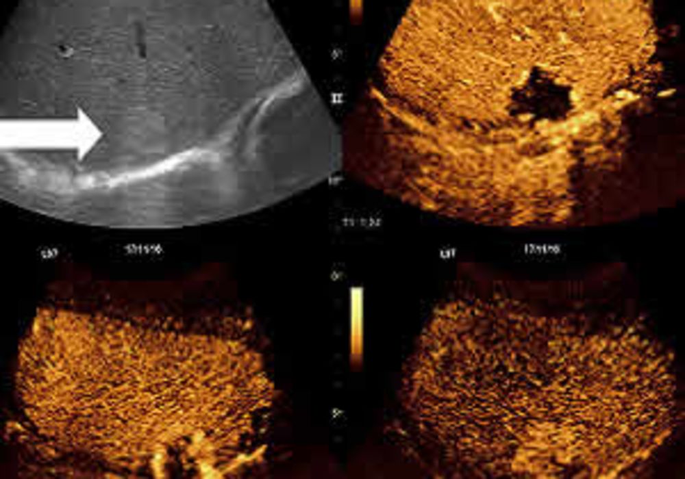 Contrast-enhanced ultrasound for detecting combined hepatocellular cholangiocarcinoma