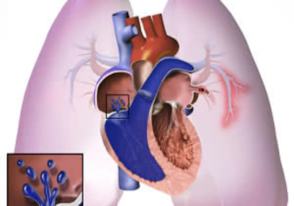 Echo indices for RVEF monitoring in pulmonary hypertension