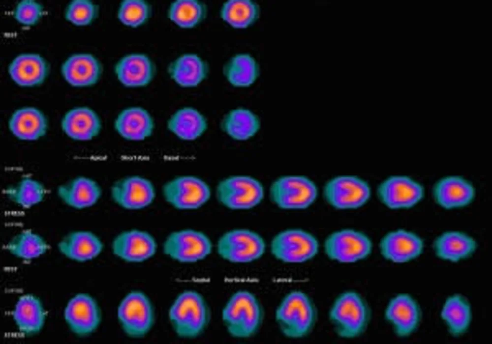 Thrombectomy for ischaemic stroke with selection by perfusion imaging