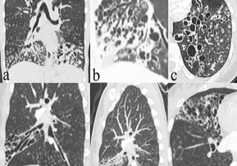 Typical features of primary ciliary dyskinesia on CT