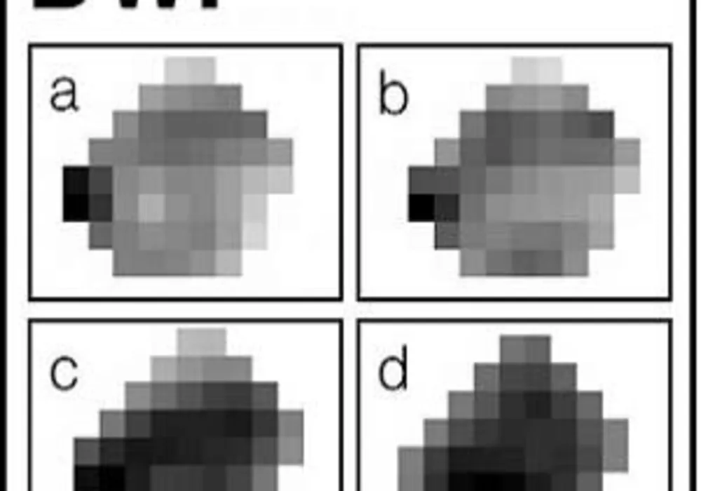 Breast MRI technique increases cancer detection 