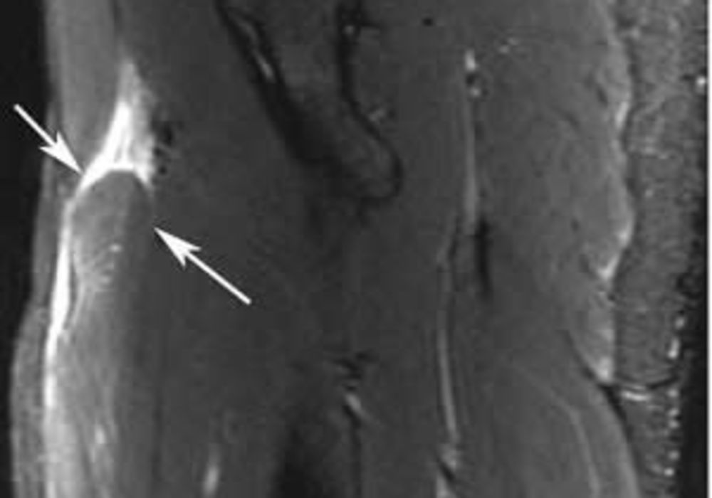 Fat-suppressed T2-weighted MR imaging demonstrates distal retraction of proximal rectus femoris muscle (arrows). 