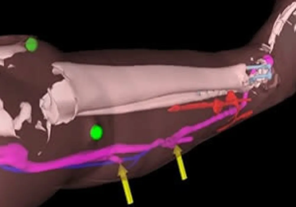 Augmented reality helps surgeons reconnect blood vessels 