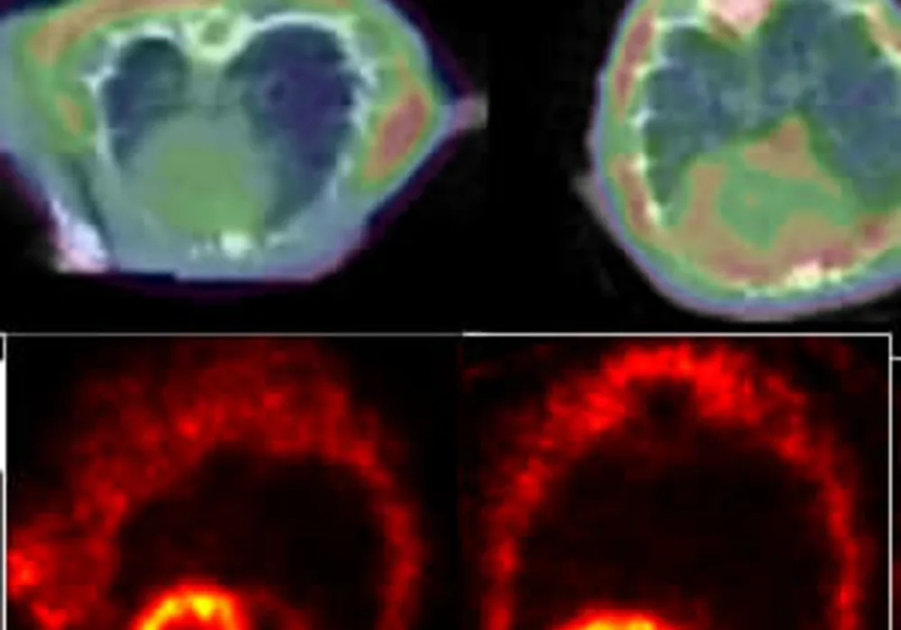 A PET scan detects clumping proteins in rat hearts (top). The enlarged heart (right) is one with heart failure. Other PET scans showing blood flow in the rat hearts (bottom) show that the protein clumps aren&#039;t due to circulation problems.