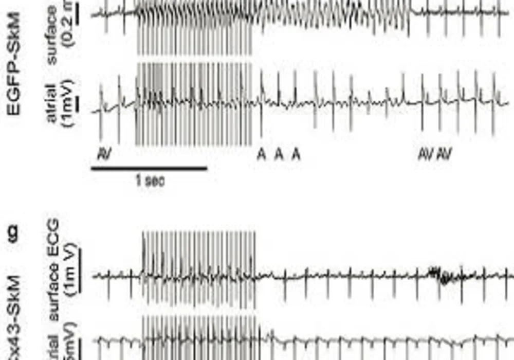 Burst stimulation induces self-terminating VT in a representative EGFP-SkM transplanted mouse in vivo.