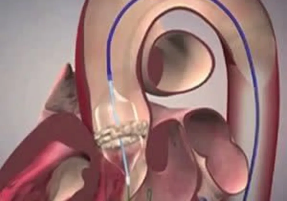 Aortic calcification can help predict post-TAVR mortality