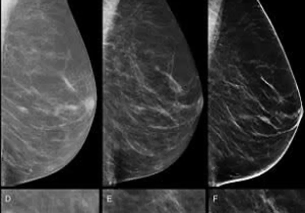 Combined digital screening detects more breast cancers