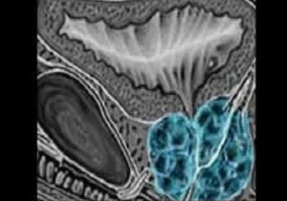 Biparametric MRI improves prostate cancer detection 