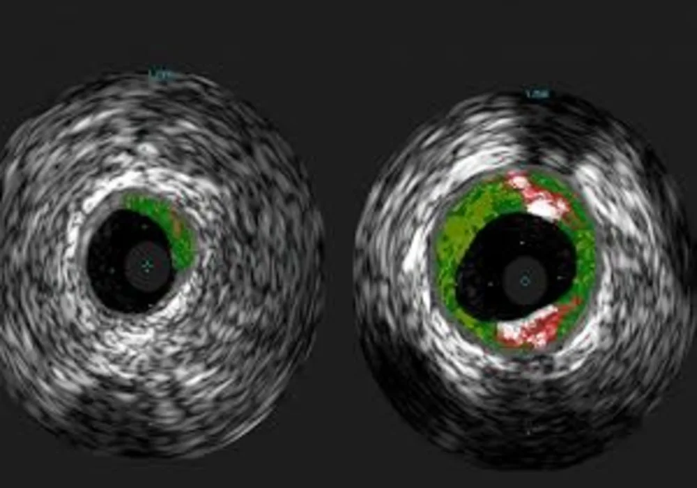 Shown are cross-sectional ultrasound images of coronary arteries from patients enrolled in the study. Plaque buildup (colored areas) in an artery from a patient that lacks sensitivity to red meat allergen (left) is much lower than plaque levels in an arte