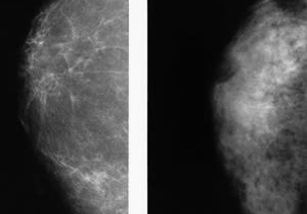 New study confirms higher cancer rate in women with dense breasts