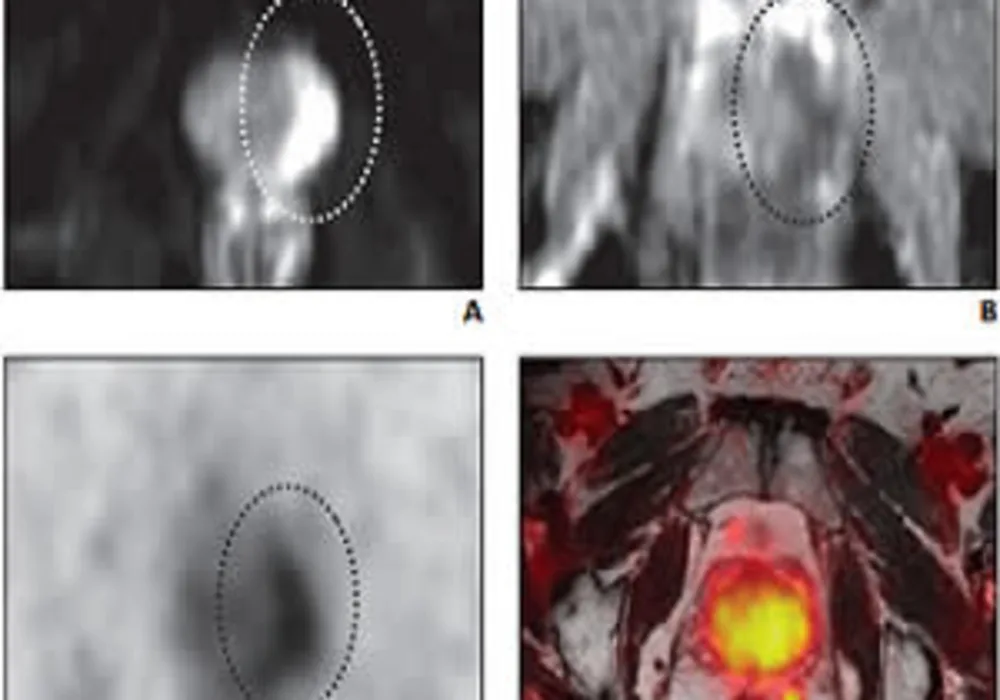 RSNA 2019: PSMA-based PET Radiotracers Transforming Care in Prostate Cancer