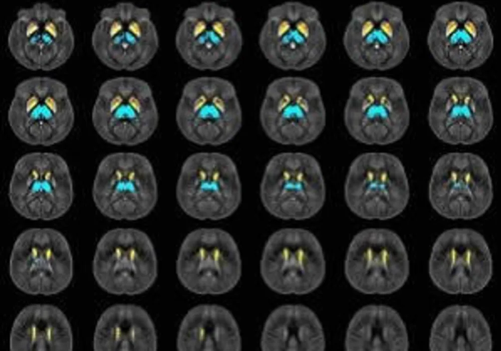 Image shows voxelwise analysis of quantitative susceptibility maps within thalamus, caudate, globus pallidus, and putamen comparing all participants with multiple sclerosis (MS) to healthy control (HC) participants. Areas of higher susceptibility in parti