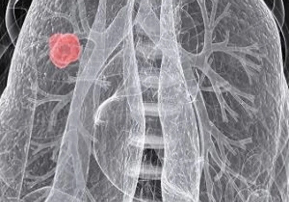 Improving performance of lung cancer screening in places with high number of nonsmokers 