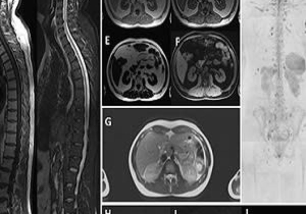 Illustration of the images acquired in the WB-MRI protocol. Whole-spine sagittal fast-spin-echo T1w (A) and T2w fat-suppressed (STIR) (B) images. Whole body (skull base to mid thighs) axial T1w thin-slice gradient-echo Dixon technique with in-phase (C), o