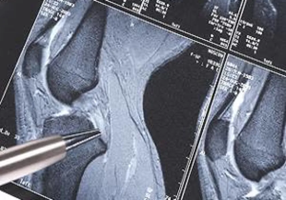 Limitations of MRI muscle injury classification system 