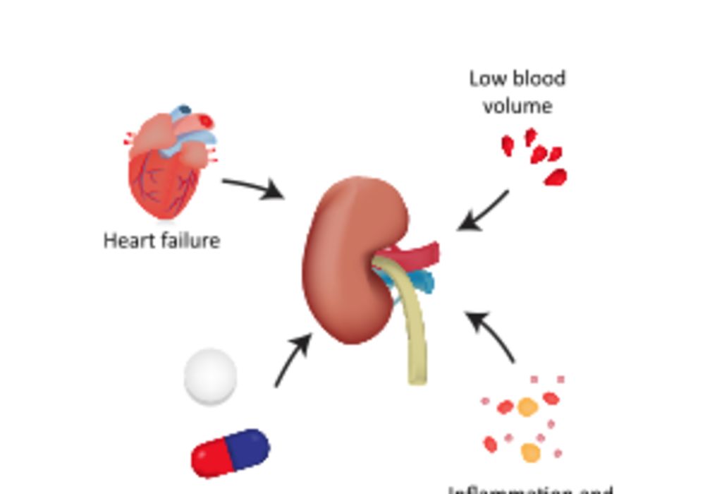 Patients with AKI and sepsis: when to initiate renal-replacement therapy