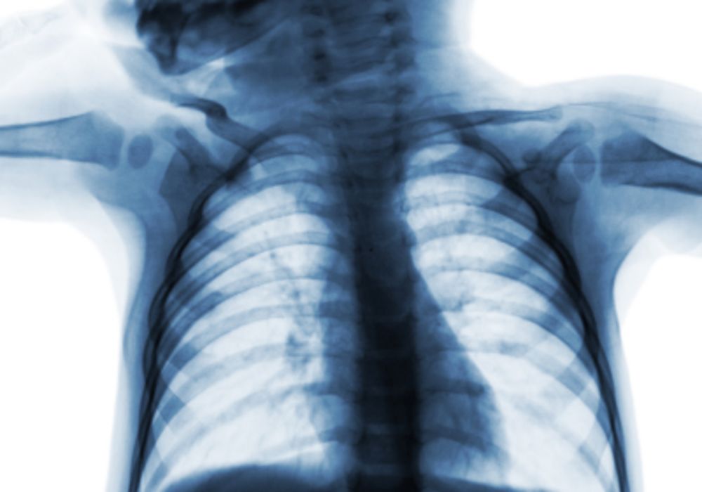 No decrease in x-rays for infants with bronchiolitis, despite guidelines 