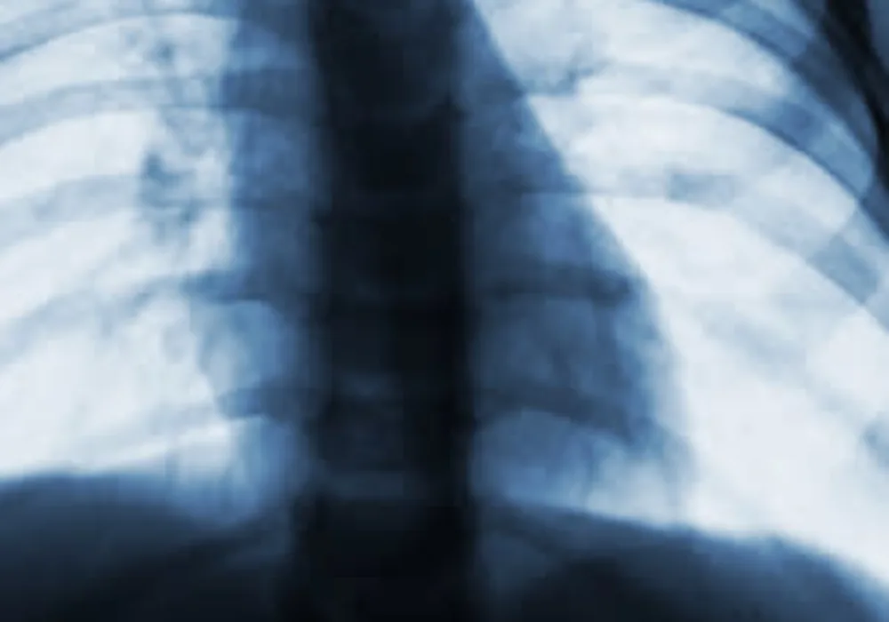 No decrease in x-rays for infants with bronchiolitis, despite guidelines 