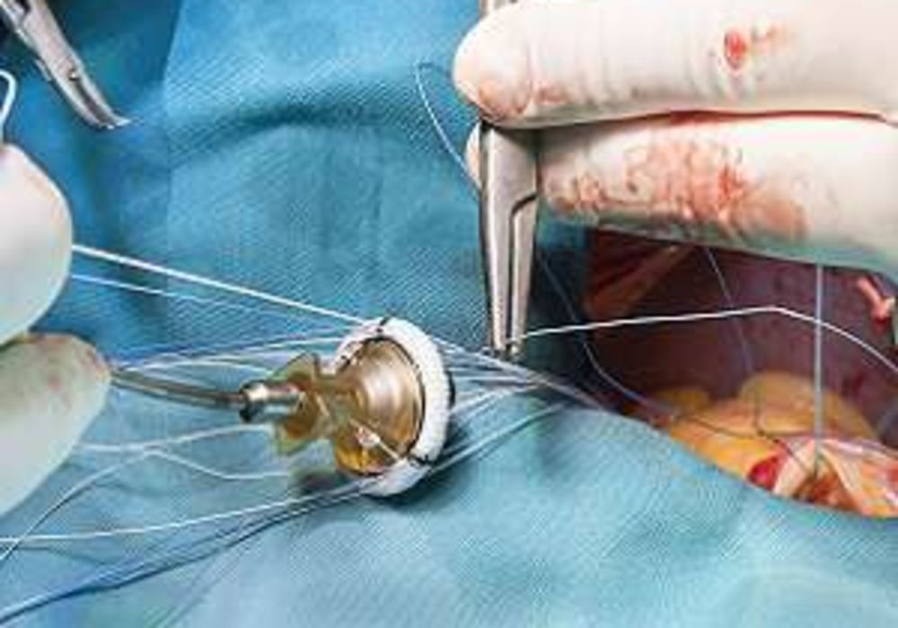 Heart valve surgery associated with cognitive decline