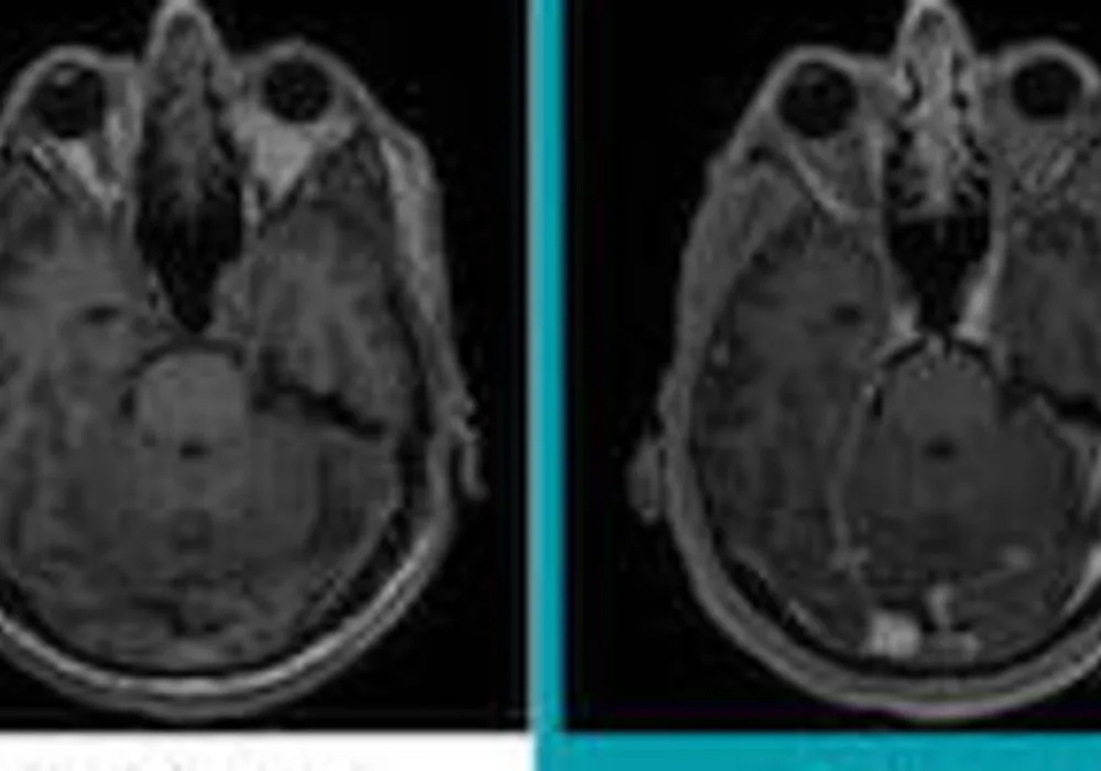 #RSNA18: AI may help reduce MRI gadolinium dose