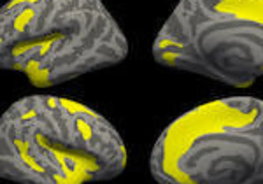 #RSNA18: MRI finds depression and anxiety brain pattern 