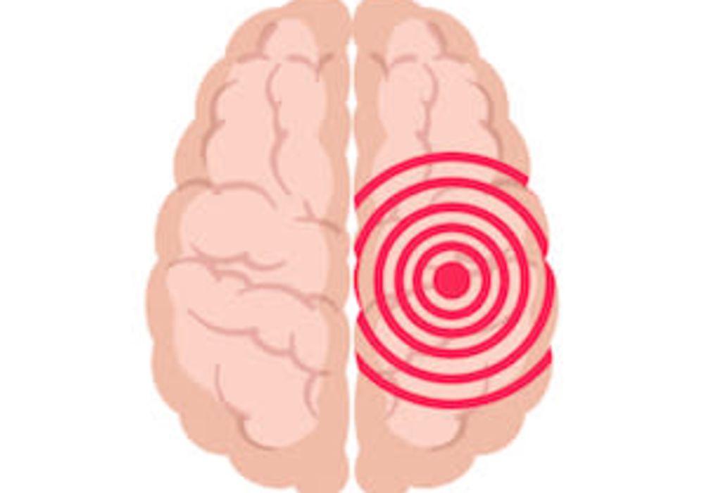 #SIR2019: Innovative training helps IR&#039;s save stroke patient lives 