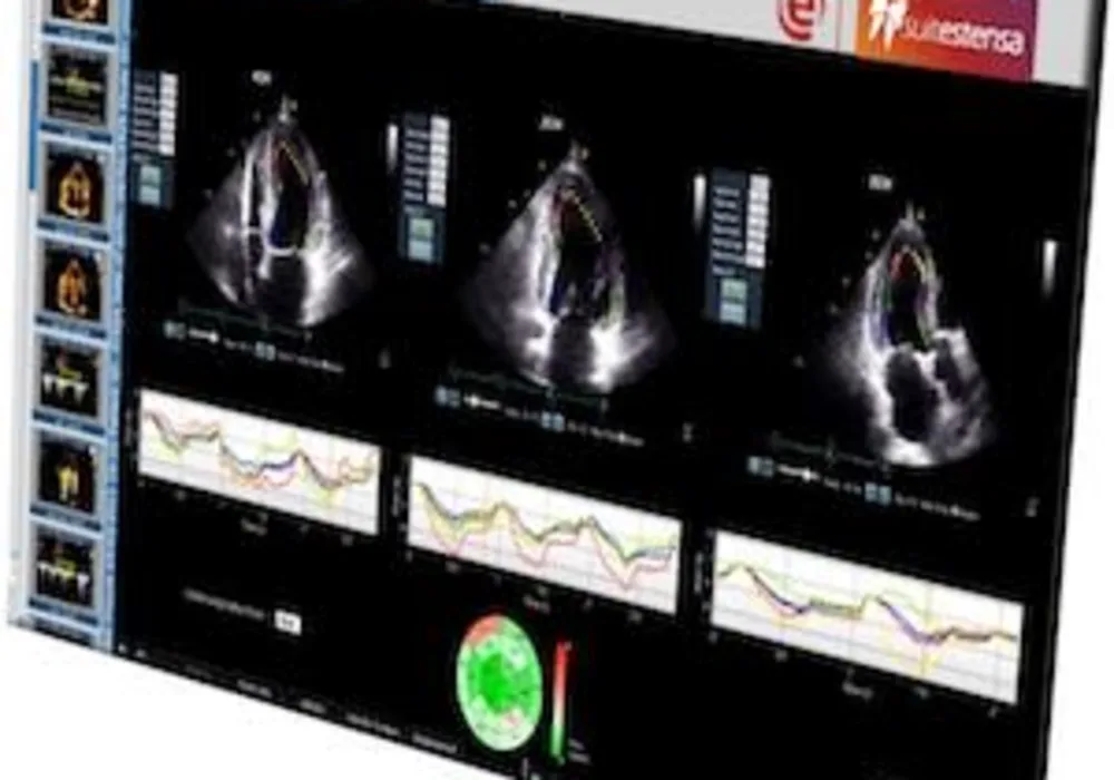 Ebit &amp; DiA Imaging Analysis partner offering Advanced AI-based Cardiac Ultrasound Analysis 