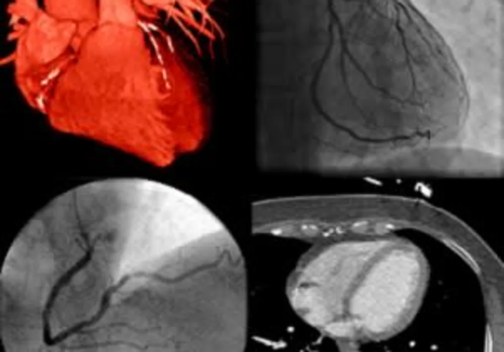 Use of imaging to guide heart attack treatment