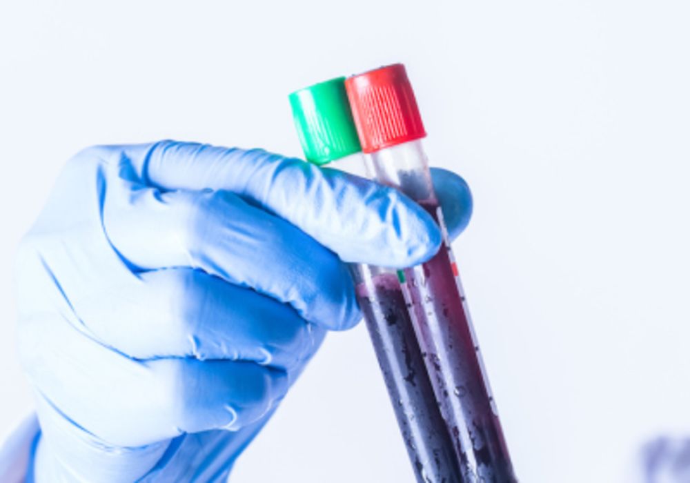 Blood Cultures Before Sepsis Treatment