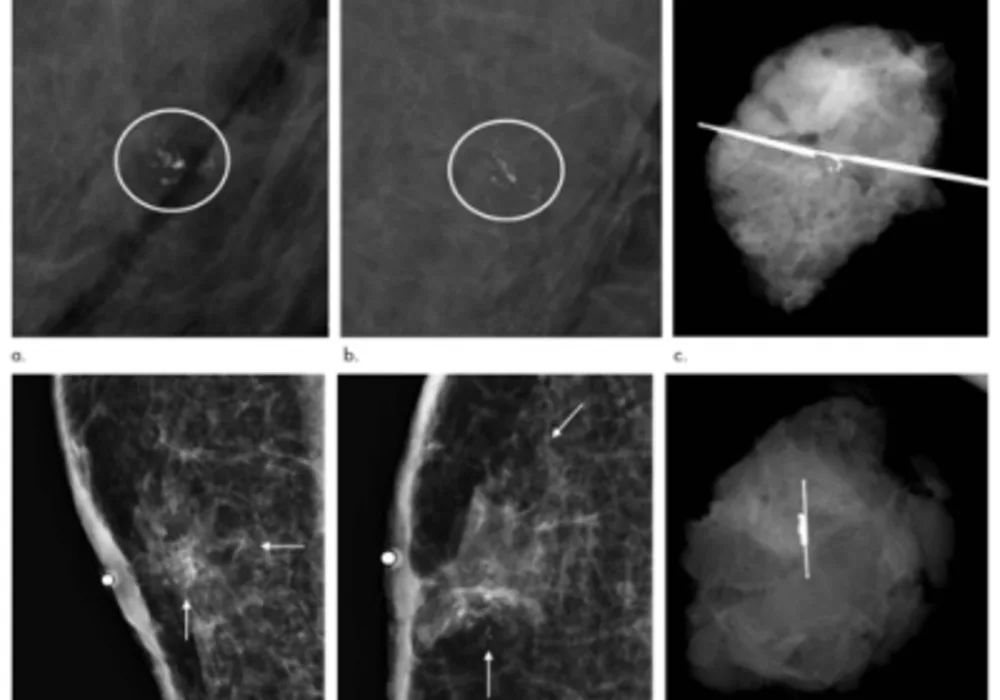 Screening Mammography for Men at Risk