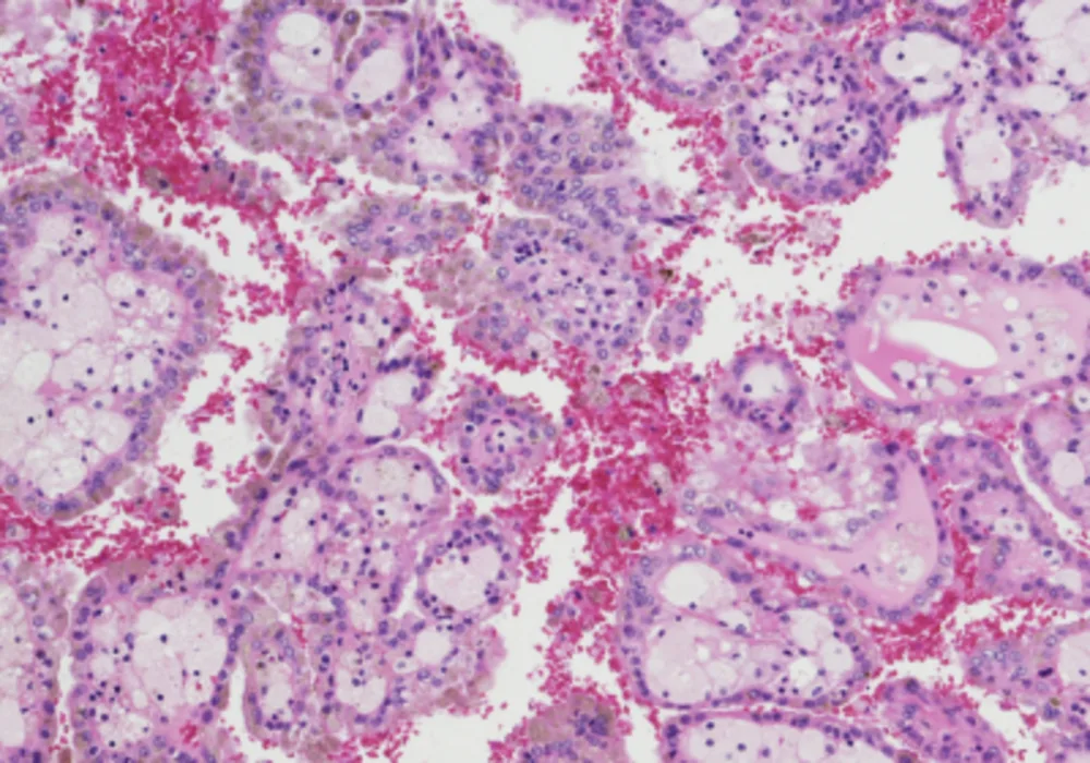 Radiogenomic Correlations in CT Imaging and MicroRNAs 