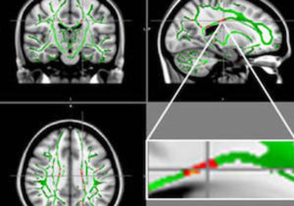 Reduction in fractional anisotrophy (FA) in obese patients compared to the control group.