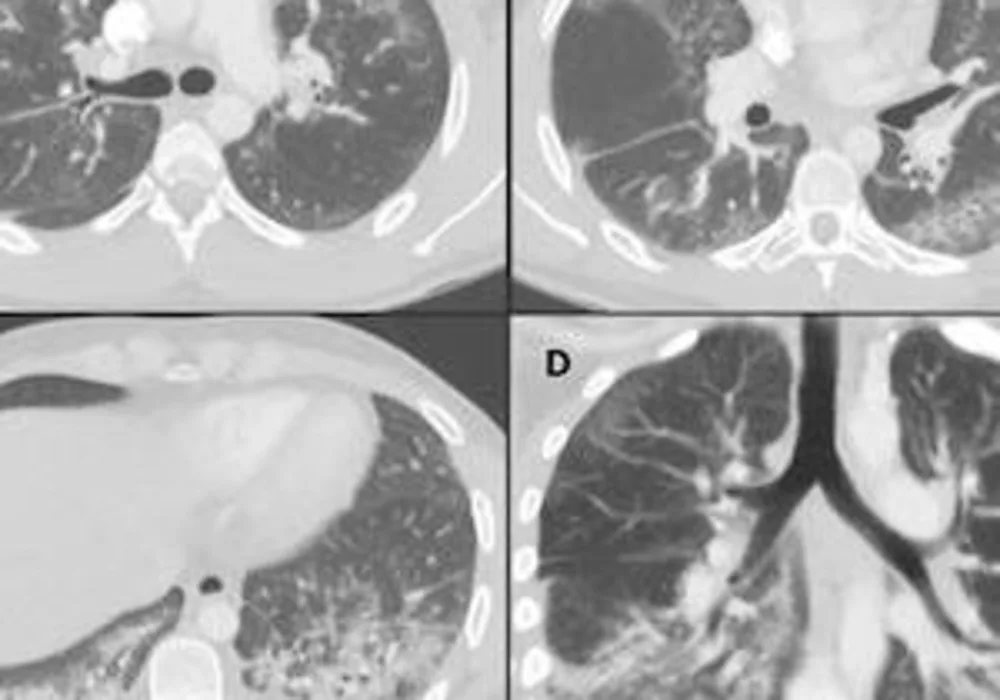  Chest CT angiographic images in a 24-year-old man with a history of e-cigarette use.